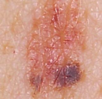 Um melanoma pode crescer em qualquer parte do seu corpo, logo é importante examinar periodicamente toda a superfície do corpo, (uma vez por mês) para detetar possíveis