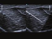 Elastografia de alta qualidade; Needle Vision : Software para visualização de agulha em procedimentos; Equipado com SSD e bateria interna - hardware