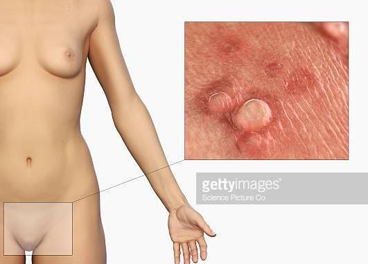 Viroses associadas ao sistema genital CONDILOMA ACUMINADO (VERRUGA GENITAL) Agente etiológico: HPV tipo II; Transmissão: contato sexual (IST), parto; Sintomas: aparecimento de verrugas (condilomas)