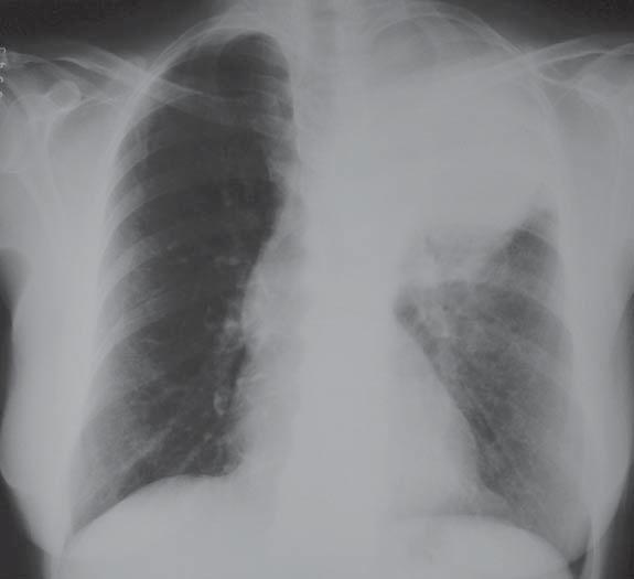 Criptococose pulmonar isolada em paciente imunocompetente 477 criptococose consiste em nódulos únicos ou múltiplos, usualmente subpleurais, variando entre 0,5 a 3 cm de diâmetro.