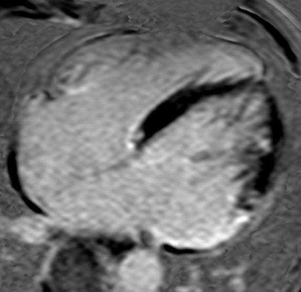 4 Resultados 38 Figura 1 - Imagem de 4 câmaras com técnica de realce tardio mostrando fibrose miocárdica no segmento lateral basal (setas brancas) 4.