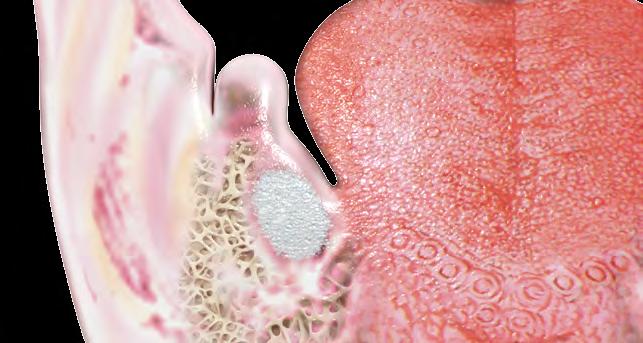 Nervo Alveolar Cartilagem de Meckel DESENVOLVIMENTO DA MANDÍBULA Nos vertebrados inferiores, a mandíbula é formada a partir da cartilagem de Meckel, mas nos seres humanos existe apenas uma estreita