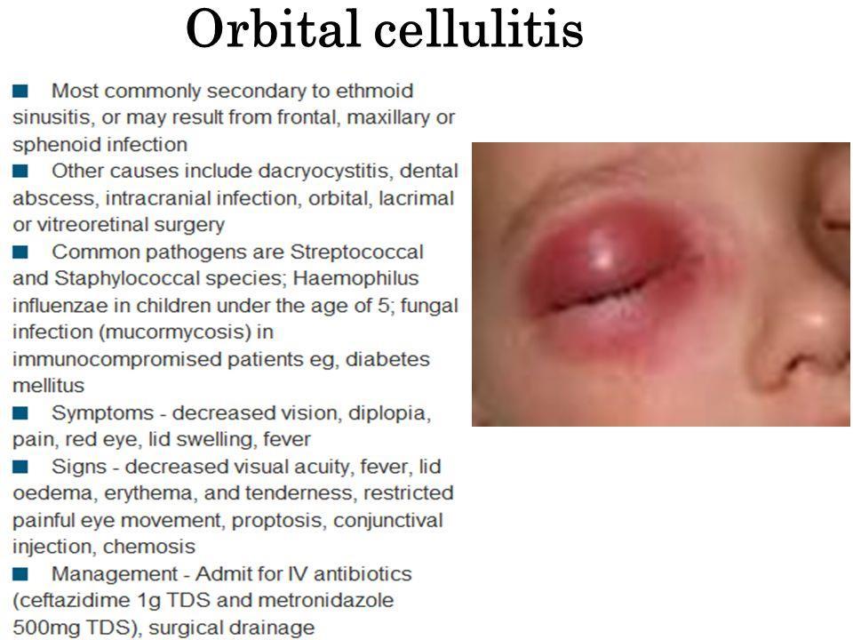 COMPLICAÇÕES CELULITE PERIORBITÁRIA Inflamação com edema periorbitário.