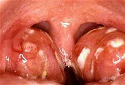FARINGOAMIGDALITE BACTERIANA ETIOLOGIA: Streptococus pyogenes (beta hemolítico do grupo A CLÍNICA: 5 15 anos Febre, dor de garganta, exsudato amigdaliano,