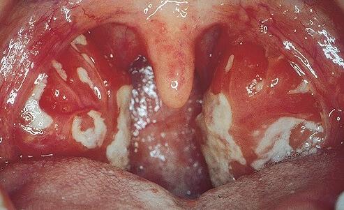 DIAGNÓSTICOS DIFERENCIAIS: Mononucleose infecciosa (vírus Epstein-Barr) Faringite, astenia, e esplenomegalia. A hepatomegalia é menos comum.