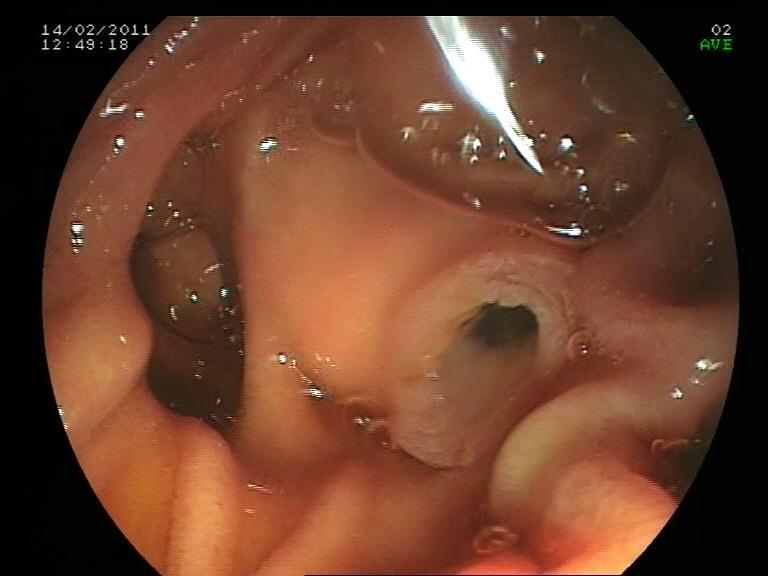 Neoplasias intraductais mucinosas papilíferas (NIMPs) Cisto de