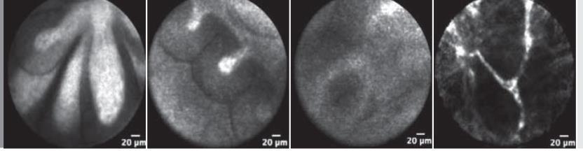laser (CLE): imagens microscópicas em tempo real de tecido assistidos por laser