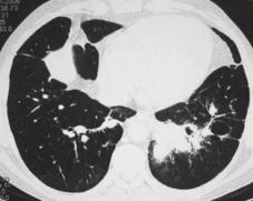 linfático é um componente normal do pulmão: a) gânglios do hilo e gânglios intrapulmonares peribrônquicos; b) folículos linfáticos da mucosa brônquica (BALT=bronchus-associated lymphoid tissue); c)