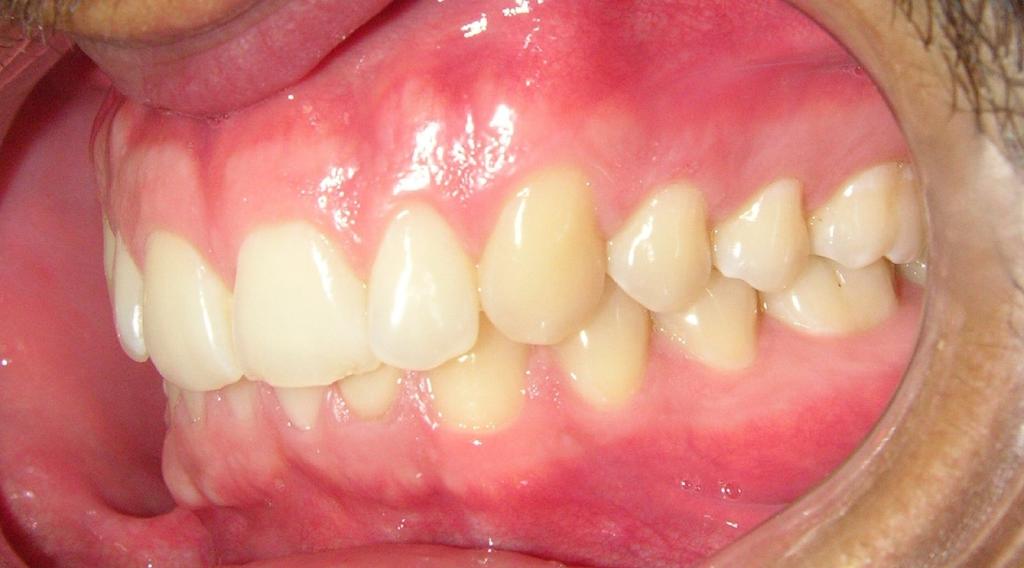 A radiografia pós-operatória revelou completa remoção da lesão (Figura 9), o histopatológico confirmou a hipótese diagnóstica de odontoma, e o mesmo encontra-se em