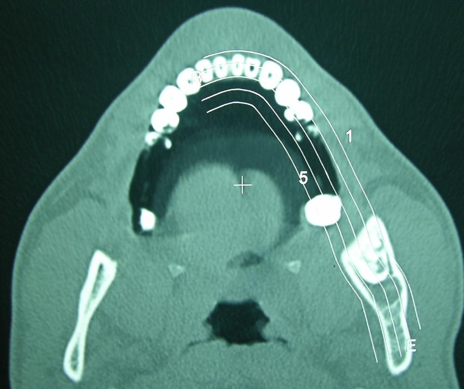 computadorizada de face em corte axial: área hipodensa associada a