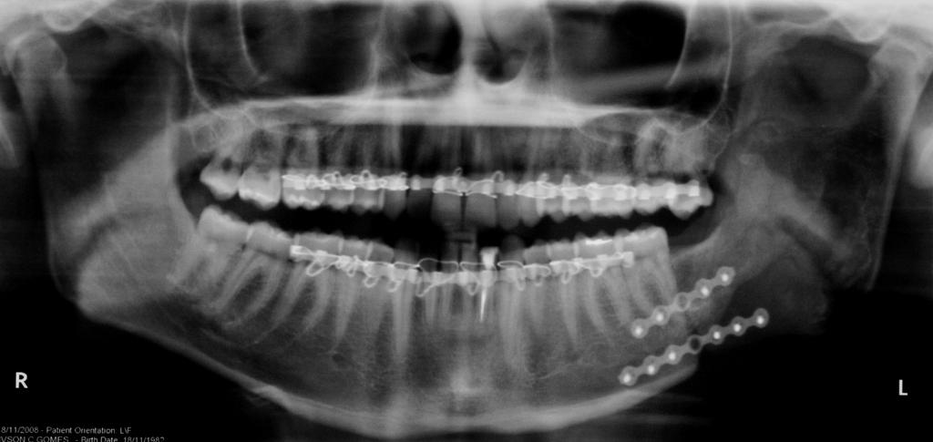 0 Figura 9- Radiografia panorâmica pós-operatória