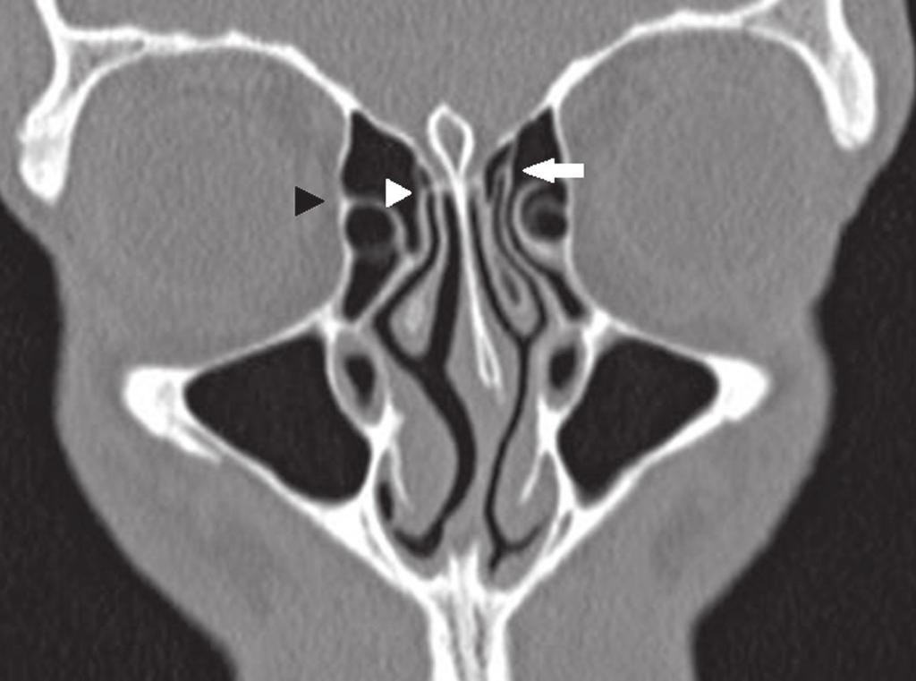 Tipo IV Inserção na junção do corneto médio com a placa cribriforme (Figura 3). Tipo V Inserção na base do crânio (Figura 2). Tipo VI Inserção no corneto médio (Figura 4).