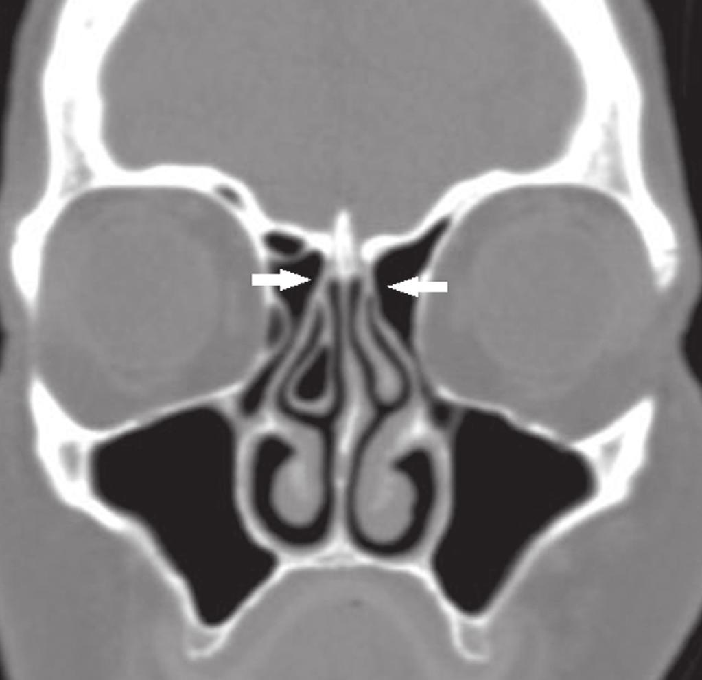 base do crânio (tipos III, IV e V) pode provocar fístulas liquóricas (1).