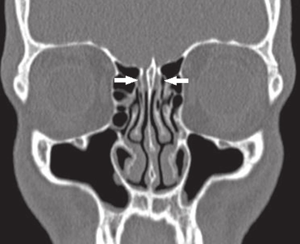 ARTÉRIA ETMOIDAL ANTERIOR A artéria etmoidal anterior é responsável pela irrigação das células etmoidais anteriores, do seio frontal, do terço anterior do septo nasal e da parede lateral do nariz,