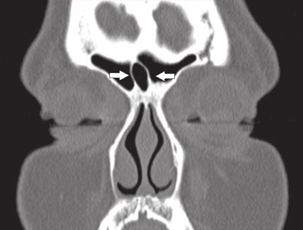 CÉLULA INTERSINUS FRONTAL Pneumatização da lamela óssea (septo) entre os seios frontais (Figura 12), podendo ser equivocadamente confundida, durante o ato cirúrgico, com o seio frontal.