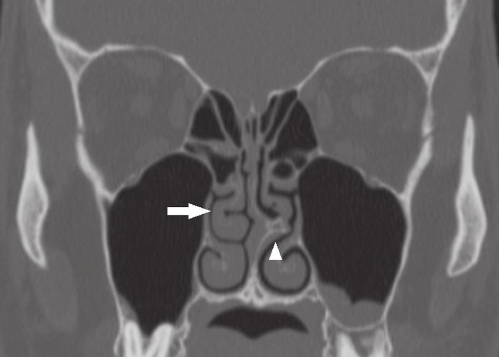 TC, janela óssea, corte coronal, demonstrando a pneumatização das porções lamelar e bulbosa dos cornetos nasais médios (setas). Figura 17.