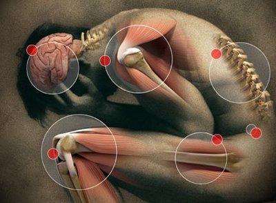 Síndrome de Guillain-Barré A síndrome de Guillain-Barré é uma doença de ocorrência rara caracterizada por fraqueza em braços e pernas e, que pode progredir causando paralisias e afetando inclusive os