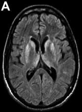 Doença de Creutzfeldt Jakob Diagnóstico: EEG: atividade periódica