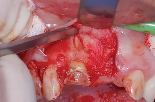 15, o retalho foi elevado. Foi realizada osteotomia com broca de alta rotação da serie 700, para ter acesso á região periapical. A lesão foi curetada com curta.