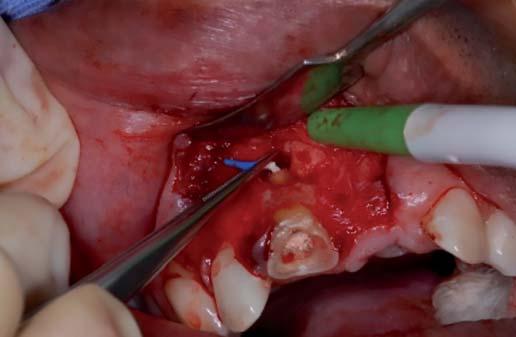 Foi realizada uma apicectomia cuidadosa, conservando assim, o máximo possível de estrutura dental.