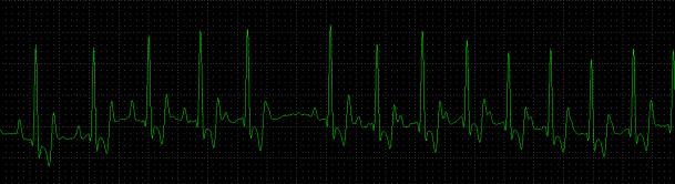 ??) Outros mecanismos de ação Fibrilação Atrial Classe I Classe I Estabilizadores de membrana Reduzem a excitabilidade da membrana celular Interferem com canais rápidos de sódio Redução na