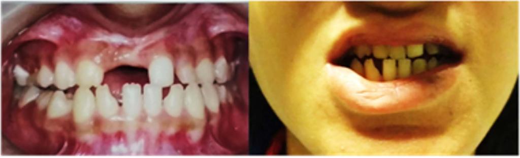 FIGURA 2. A esquerda observa-se anodontia superior com microdontia inferiormente; A direita observa-se correção cirurgica com implantes dentários superiores. FIGURA 3.