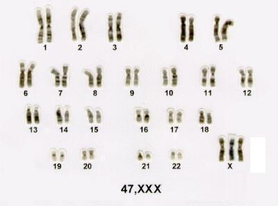 Ocorre em mulheres que apresentam um cromossomo X extra.