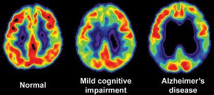 Aplicações da radiação ionizante PET (Positron Emission Tomography) TEP (Tomografia por Emissão de Positrões) Cérebro