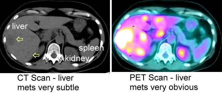 Aplicações da radiação ionizante PET (Positron Emission Tomography) TEP (Tomografia por Emissão de Positrões) Fígado Exame CT* Tumores