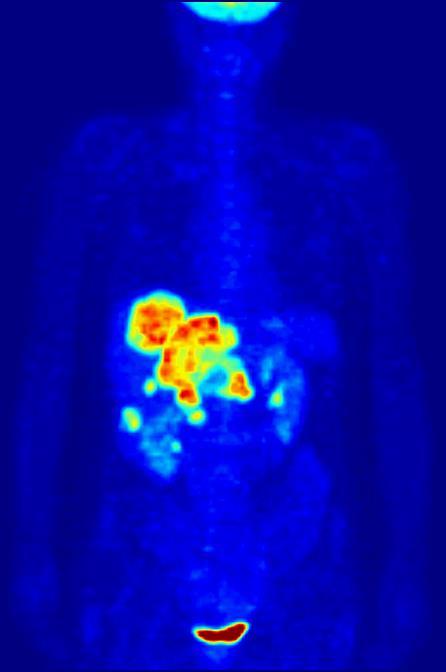 Aplicações da radiação ionizante PET (Positron Emission Tomography) TEP (Tomografia