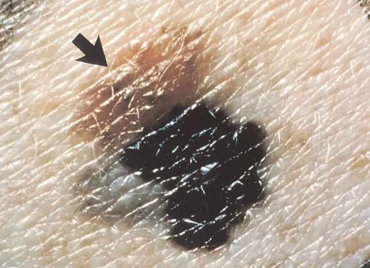 14 FIGURA 1 Foto mostrando um melanoma assimétrico com bordas irregulares FONTE: (NATIONAL CANCER INSTITUTE, 2010) O melanoma pode variar em suas características, sendo que aqueles que estão em