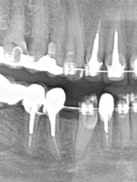 Em decorrência da movimentação e acomodação dentária, que ocorre após exodontia ou em decorrência de anodontias, o espaço para reposição do dente ausente pode se apresentar menor ou maior do que o