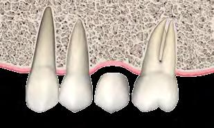 Reabilitação Oral ACRÉSCIMO DE RESINA NAS PROXIMAIS DOS DENTES ADJACENTES Quando as ausências dentárias levaram a um espaço protético maior que o necessário para reposição do dente perdido e o