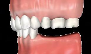 DESGASTE DE ANTAGONISTA EXTRUÍDO A ausência dentária também pode acarretar movimentação vertical do dente antagonista, ou seja, a sua extrusão.