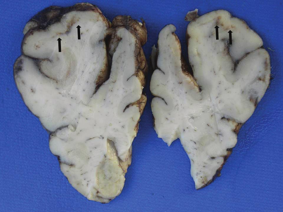906 Guilherme R. Blume et al. Fig.3. Encéfalo de um bovino com meningoencefalite herpética. Linhas de separação entre a substância cinzenta a branca do telencéfalo frontal (setas). Fig.4.