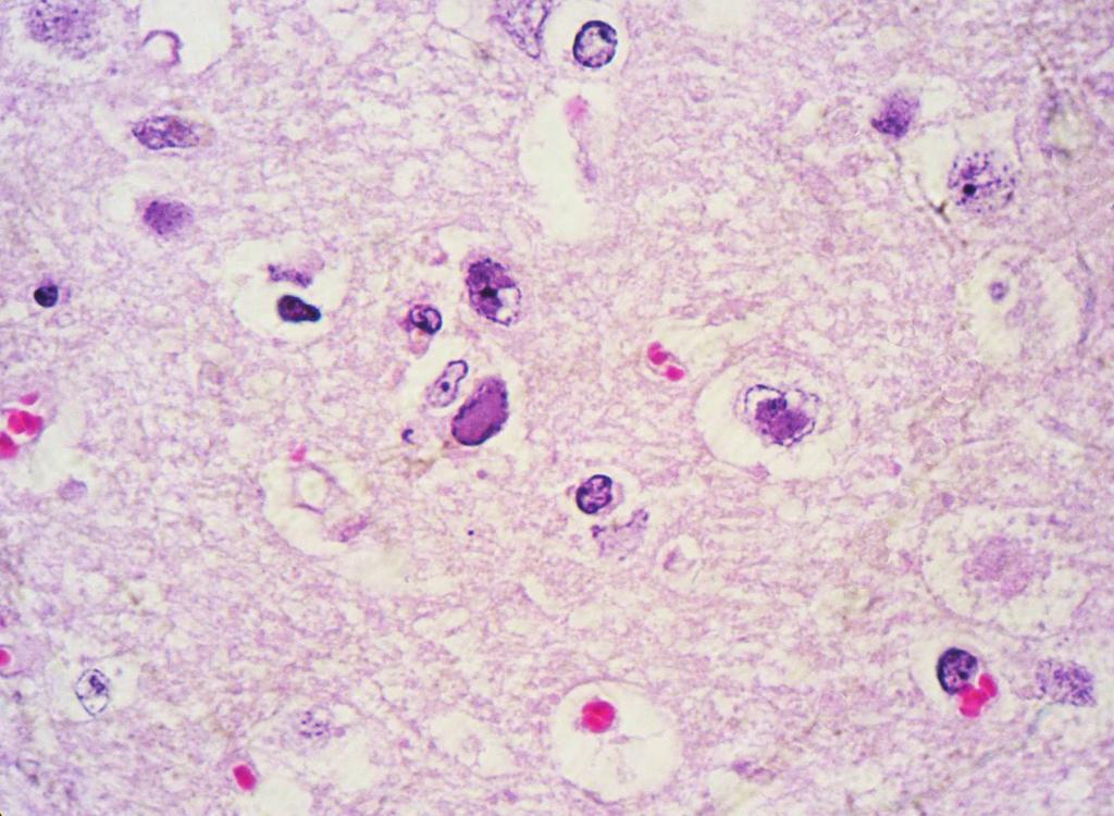 Aspecto histológico do córtex telencefálico de um bovino com meningoencefalite herpética mostrando corpúsculos de inclusão intranucleares basofílicos em astrócitos. HE, obj.40x. (Fig.