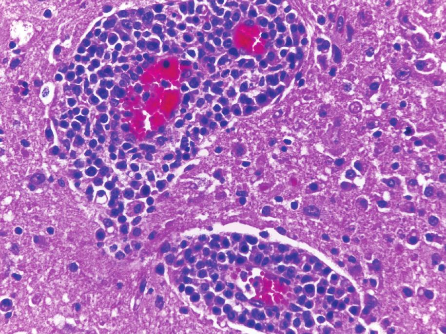 Ocasionalmente eram observados grupos de dois ou três astrócitos com núcleos vesiculosos e tumefeitos, morfologia compatível com astrócitos Alzheimer tipo II (Fig.