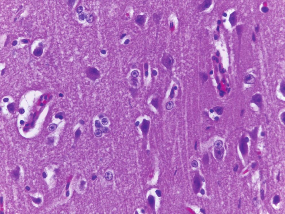 Aspecto histológico do córtex telencefálico de um bovino com meningoencefalite herpética mostrando grupos de dois a quatro astrócitos com núcleos vesiculosos e tumefeitos (astrócitos