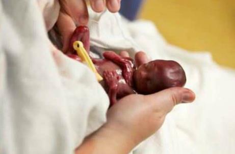 LESÕES GRAVÍSSIMAS Aborto A lesão corporal seguida de aborto (aborto preterintencional), quando a gravidez é conhecida ou manifesta,