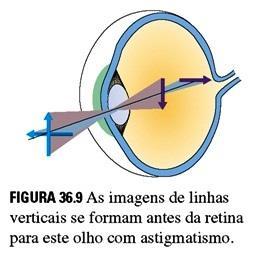 Astigmatismo O olho normal é denominado estigmata e possui uma córnea perfeitamente esférica.