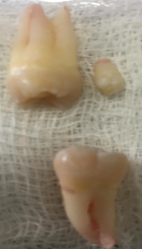 18 Figura 9 Dentes extraídos : 28, 38 e o quarto molar.