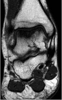 318 Figura 14: Ressonância magnética 4 anos pós-operatório (frontal) DISCUSSÃO OS TTSCG são uma doença rara mas localmente invasiva com potencial significativo para morbilidade articular grave.
