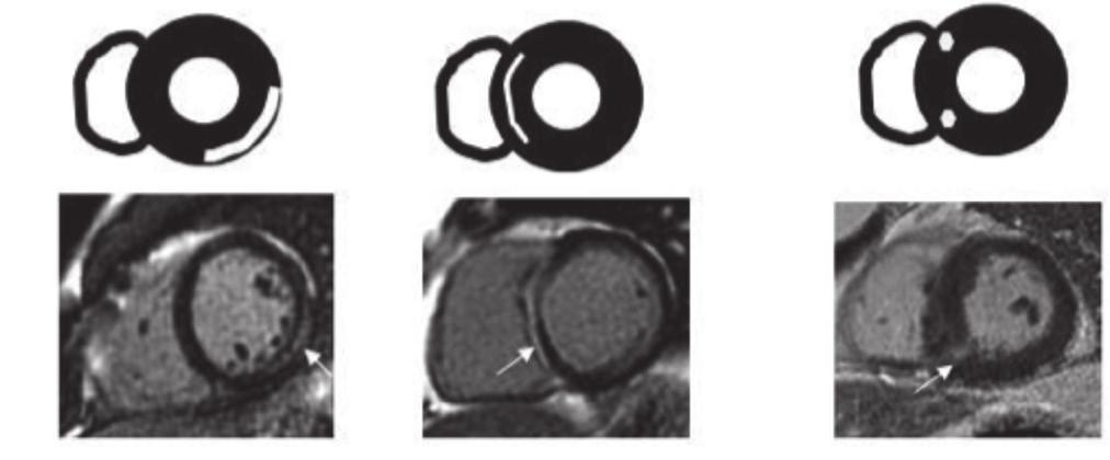 Figura 9 Padrões de imagens de ressonância magnética após contraste refletindo a lesão do miocárdio isquémica e não isquémica ISQUÉMICA Transmural Subendocárdica Subendocárdica focal NÃO ISQUÉMICA