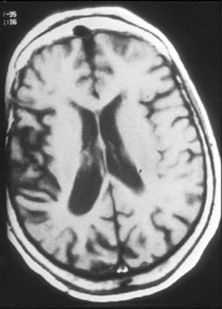 Parkinsonismo atípico: degeneração corticobasal