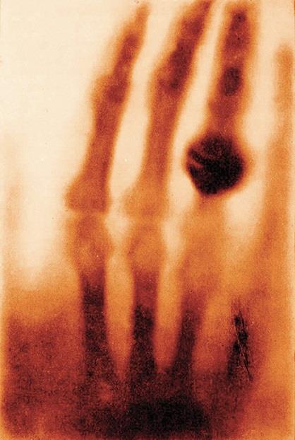 Roentgen, 1895 Descoberta raios-x: 0.