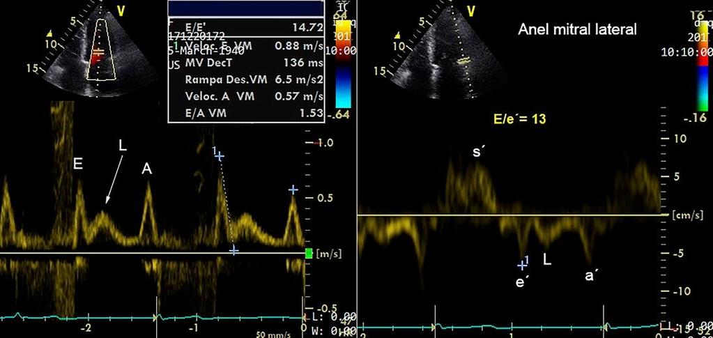 Quando a FE está diminuída e há insuficiência cardíaca importante, a relação E/e apresenta menor precisão, pois a onda E mitral pode estar diminuída devido ao baixo débito (27).