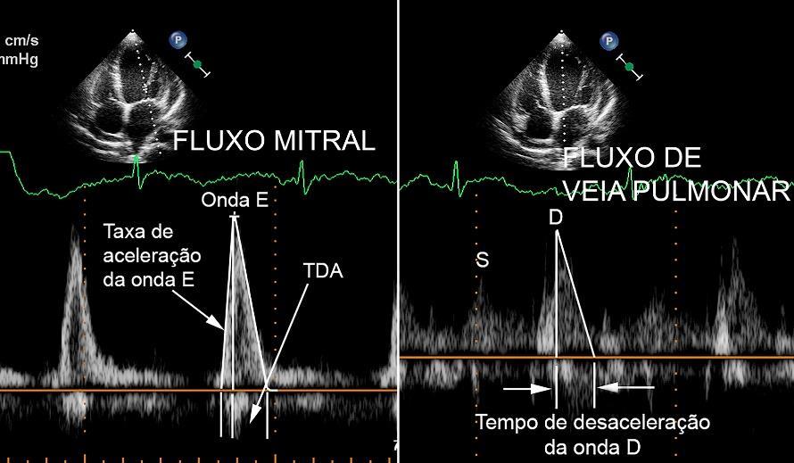Figura 10 Fluxometria Doppler mitral (esquerda) e de veia pulmonar (direita) em paciente com fibrilação atrial com as medidas do tempo de desaceleração da onda E mitral e da onda D do fluxo de veia