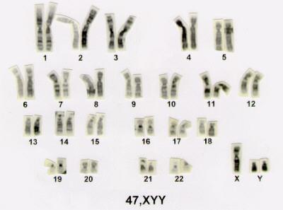 - Síndrome do duplo Y (Trissomia XYY): Na maioria das vezes o cariótipo é 47, XYY.