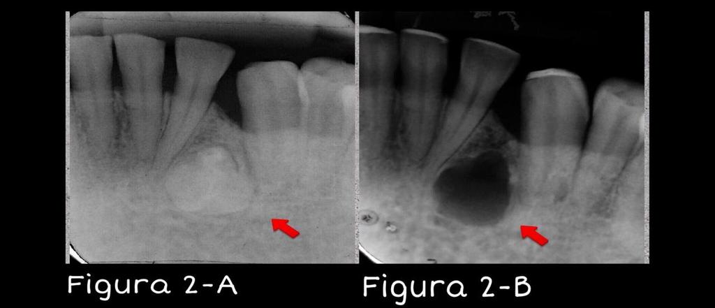 Figura 1- Odontoma complexo. Observa- se uma imagem radiopaca única circundada, por um halo radiolúcido, na região anterior da mandíbula, entre os dentes 32 e 33. Figura 2-A Odontoma complexo.