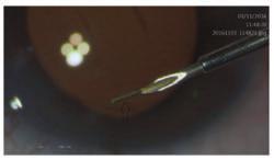 17 Figura 1a XEN Gel Implant visível na agulha do injetor 9.